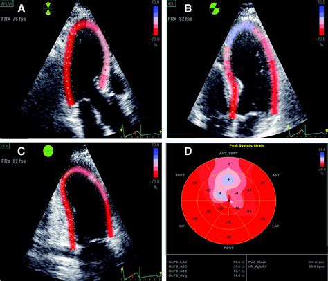 lv global hypokinesis|global longitudinal strain prognosis.